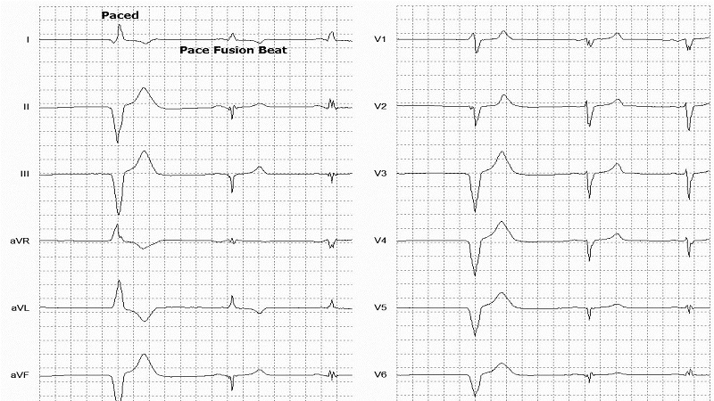Fusion of paced and normal beat 12 Lead EKG
